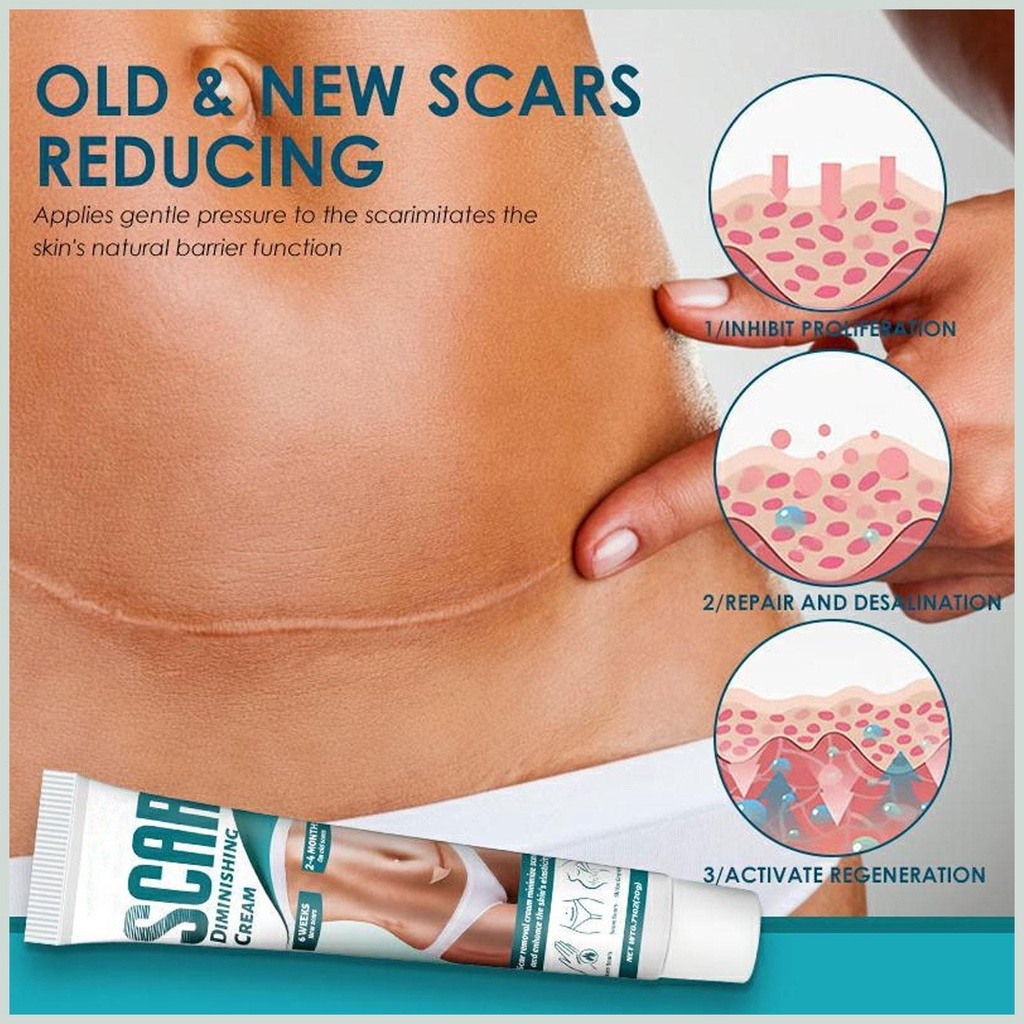 Kem Phẳng Mờ Sẹo Rạn Da Scar Diminishing Cream - Kem Dưỡng Ẩm Giảm Vết Rạn Da Mờ Sẹo Giúp Da Tăng Sự Đàn Hồi Da