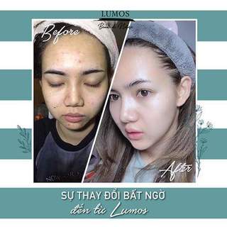 Serum giảm mụn, chấm thâm mụn Lumos Acne 5ml