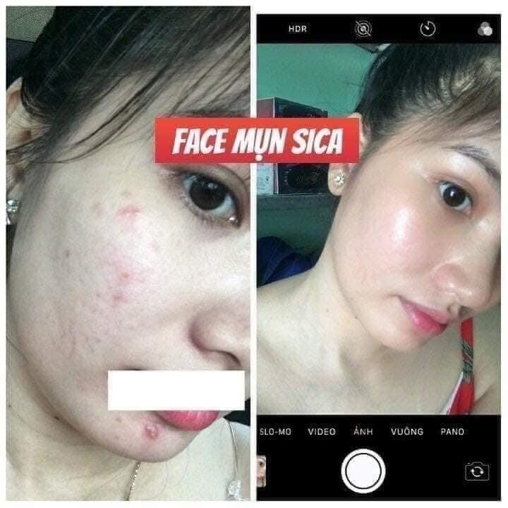 Kem mụn Ance Sica White 15G, Hỗ Trợ Mụn, Sáng Da, Mờ Thâm, Ngăn Ngừa Sẹo Mụn - SICA WHITE