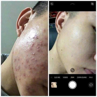 Serum mụn caramel essence