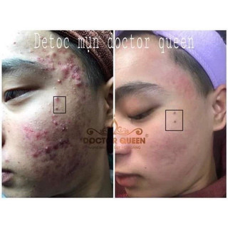 (Mẫu mới đổi tên )Detox hỗ trợ mụn, da không đều màu, sáng trắng da doctor queen
