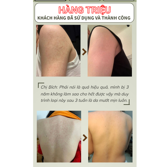 Kem Dưỡng Da Viêm Nang Lông, Cấp Ẩm Urea - Kem Urea Vitamin E Hỗ Trợ Khắc Phục Da Vẩy Nấm, Viêm Nang Lông, Mụn Body