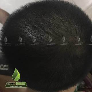 Serum mọc râu tóc Minoxidil 5% dạng bọt
