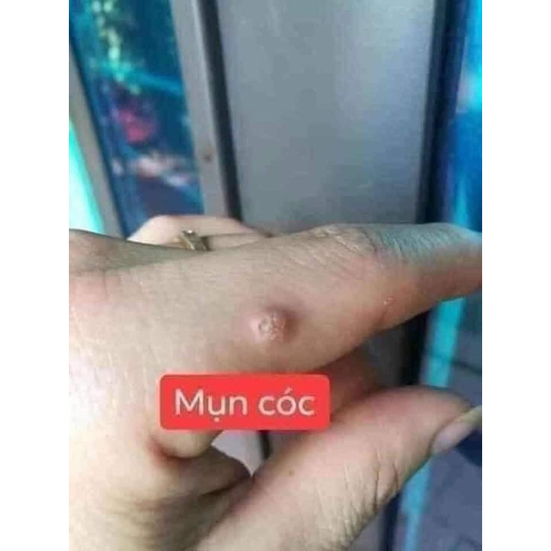 Tẩy mụn cơm, mụn cóc ,nốt ruồi, sùi mào gà viện da liễu