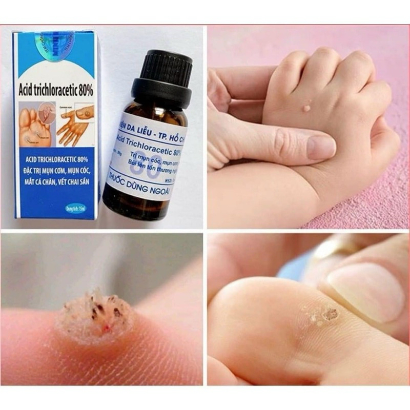 Tẩy mụn cơm, mụn cóc ,nốt ruồi, sùi mào gà viện da liễu
