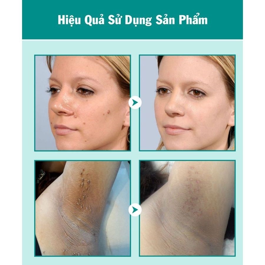 Kem Rụng Mụn Thịt Dư Cao Cấp Keyou - Kem Giúp Bật Gốc Cồi Mụ Thịt Dư, Nốt Ruồi, Mụn Cóc
