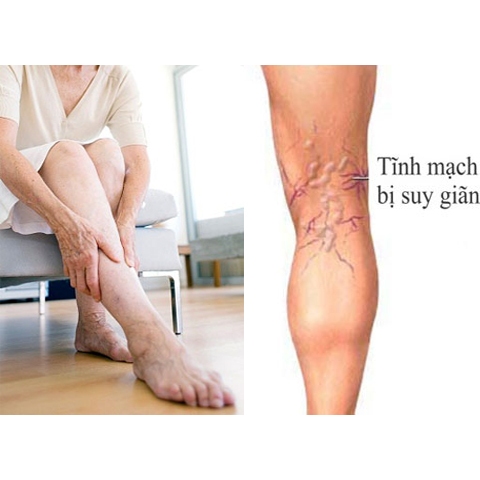 Kem Giãn Tĩnh Mạch Senjoko Nhật Bản 50g - Kem Senjoko Hỗ Trợ Tuần Hoàn Mao Mạch, Chăm Sóc Tĩnh Mạch Hiệu Quả
