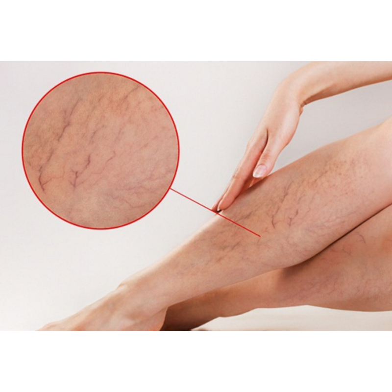 Kem Giãn Tĩnh Mạch Senjoko Nhật Bản 50g - Kem Senjoko Hỗ Trợ Tuần Hoàn Mao Mạch, Chăm Sóc Tĩnh Mạch Hiệu Quả