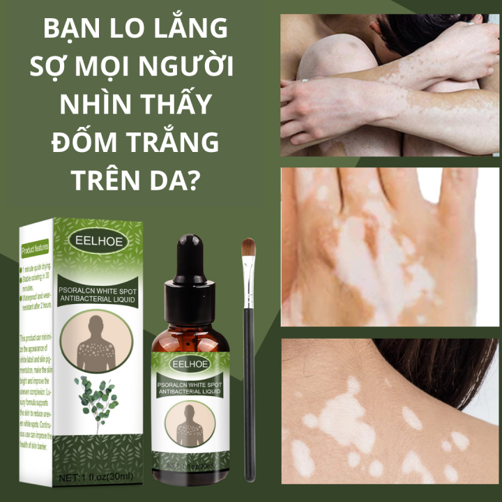 Tinh Chất Bạch Biến Eelhoe - Serum Eelhoe  Loại Bỏ Nấm Ngứa, Lang Ben, Da Cơ Địa, Bạch Biến, Cải Thiện Sắc Tố Da