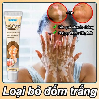 Kem loại bỏ bạch biến Kem lang ben 20g Loại bỏ đốm trắng Phục hồi tông màu da và không tái phát