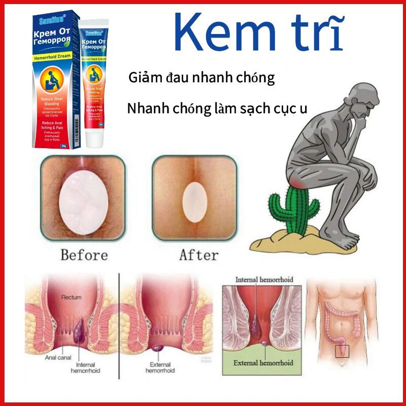 Kem bôi trĩ gel Hỗ Trợ Giảm Bệnh Trĩ giúp co búi trĩ đau rát hậu môn làm giảm sưng trĩ Chảy máu khi đi tiêu