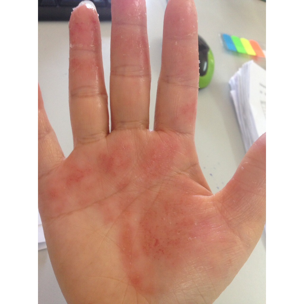 Thảo Dược Hết Sạch bong da tay và bong da chân (Đông Y Cổ Truyền)