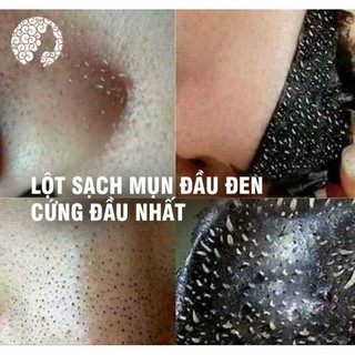 Gel lột mun than tre