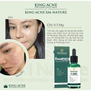King Acne nhà XM NATURE là sản phẩm hoàn hảo nhất dành cho những bạn da mụn