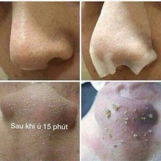[Mẫu Mới] Dung Dịch Ủ Mụn Remove Blackhead