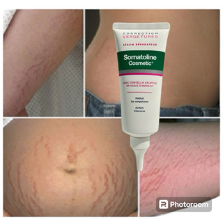 Serum Phục Hồi Vết Rạn Da Somatoline Cosmetic Correction Stretch Marks Repair Serum 100ml