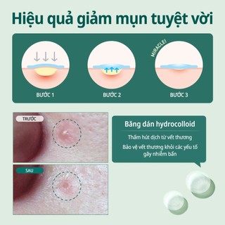 Combo 2 Miếng Dán Giảm Mụn Some By Mi Clear Spot Patch (Set 18 miếng) x 2