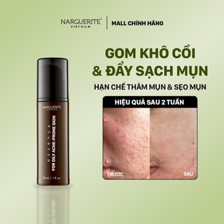 Nhũ Tương Kiềm Dầu Làm Sạch Mụn, Giảm Viêm Mụn, Gom Khô Cồi Mụn, Hạn Chế Thâm Mụn 30g
