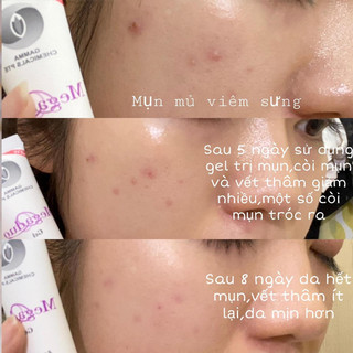 Megaduo Kem Giảm Mụn Mờ Thâm ... ( Chính Hãng )