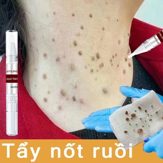Tẩy nốt ruồi chấm nốt ruồi Loại bỏ mụn cóc, Mụn Cơm, Mụn Thịt,mụn cóc dạng sợi , mụn đá Xóa nốt ruồi Tẩy xóa