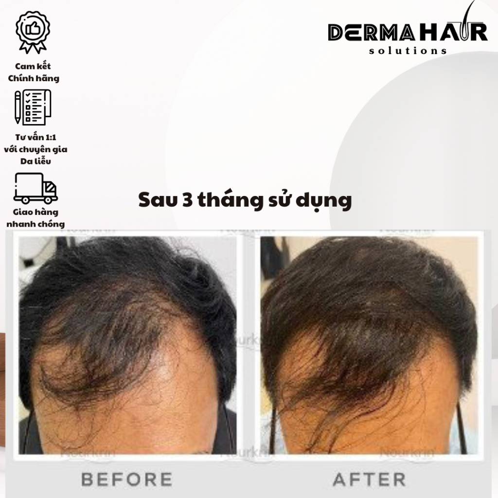 Nourkrin viên uống hỗ trợ điều trị rụng tóc từ Đan Mạch bổ trợ proteoglycan
