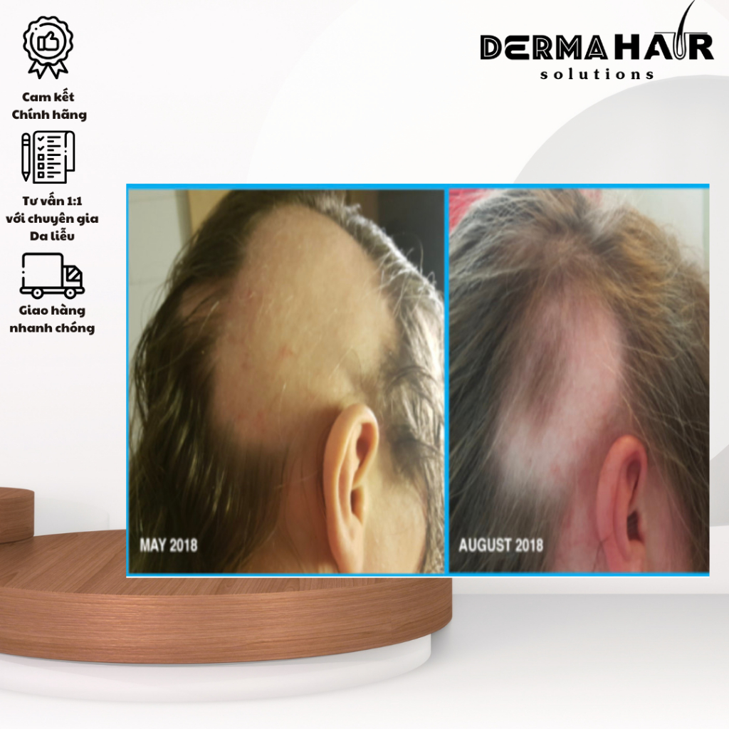 Nourkrin viên uống hỗ trợ điều trị rụng tóc từ Đan Mạch bổ trợ proteoglycan