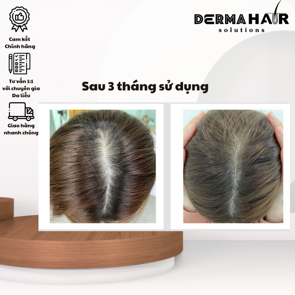 Nourkrin viên uống hỗ trợ điều trị rụng tóc từ Đan Mạch bổ trợ proteoglycan