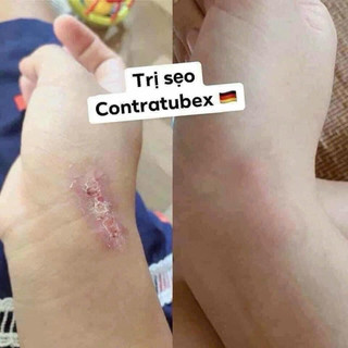 [NỘI ĐỊA ĐỨC] Kem làm mờ sẹo Contractubex (date mới)