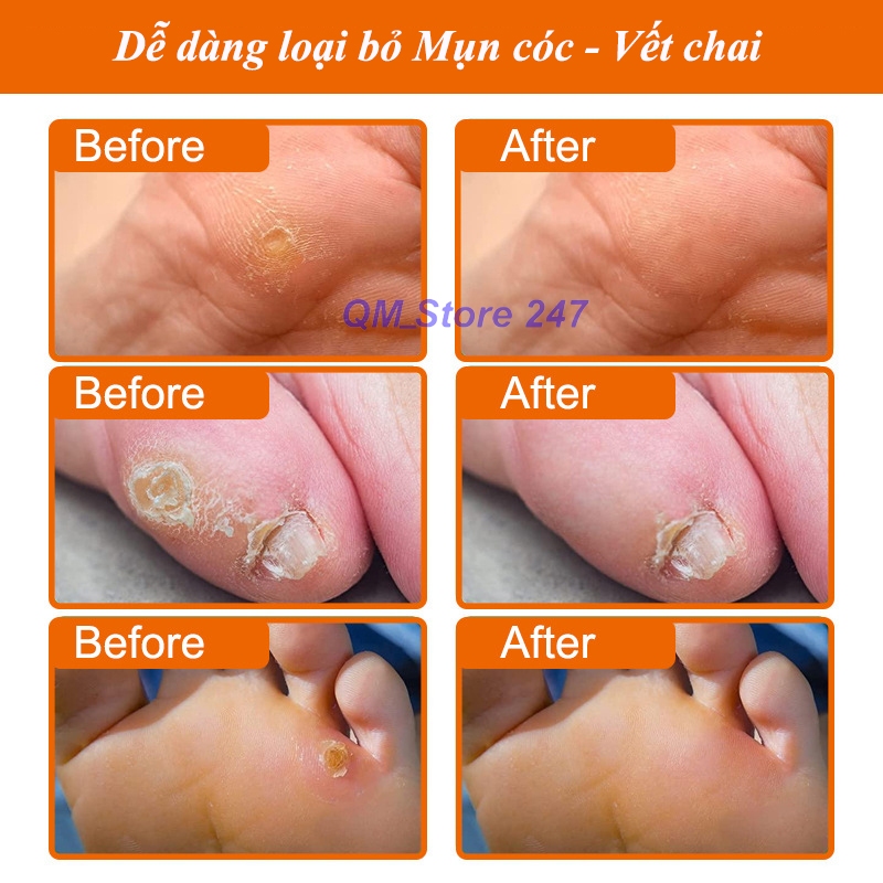 Miếng dán mụn cóc mụt cóc vết chai tẩy mụn vĩnh viễn C10 - Hộp 10 miếng