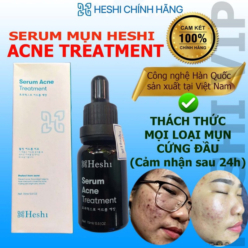Serum mụn Heshi Serum Acne Treatment 15ml chính hãng Heshi giúp loại bỏ các loại mụn hiệu quả