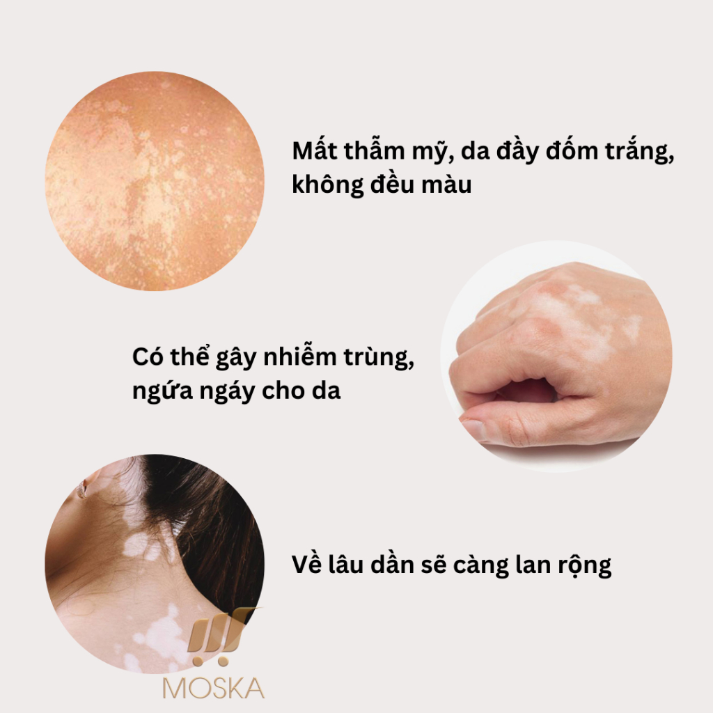 Xịt Bạch Biến Cổ Truyền Nhật Bản Loại Bỏ Da Bạch Biến, Lang Ben, Hắc Lào, Viêm Da Cơ Địa, Giúp Da Đều Màu 100ML| Moska