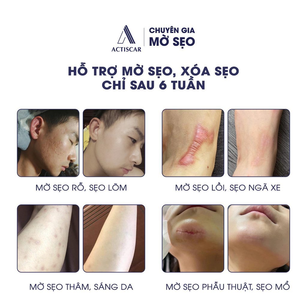 Combo Kem & Serum xóa sẹo, làm mờ sẹo lồi, sẹo rỗ, sẹo thâm mun, sẹo lõm Actiscar lâu năm nhanh chóng tại nhà