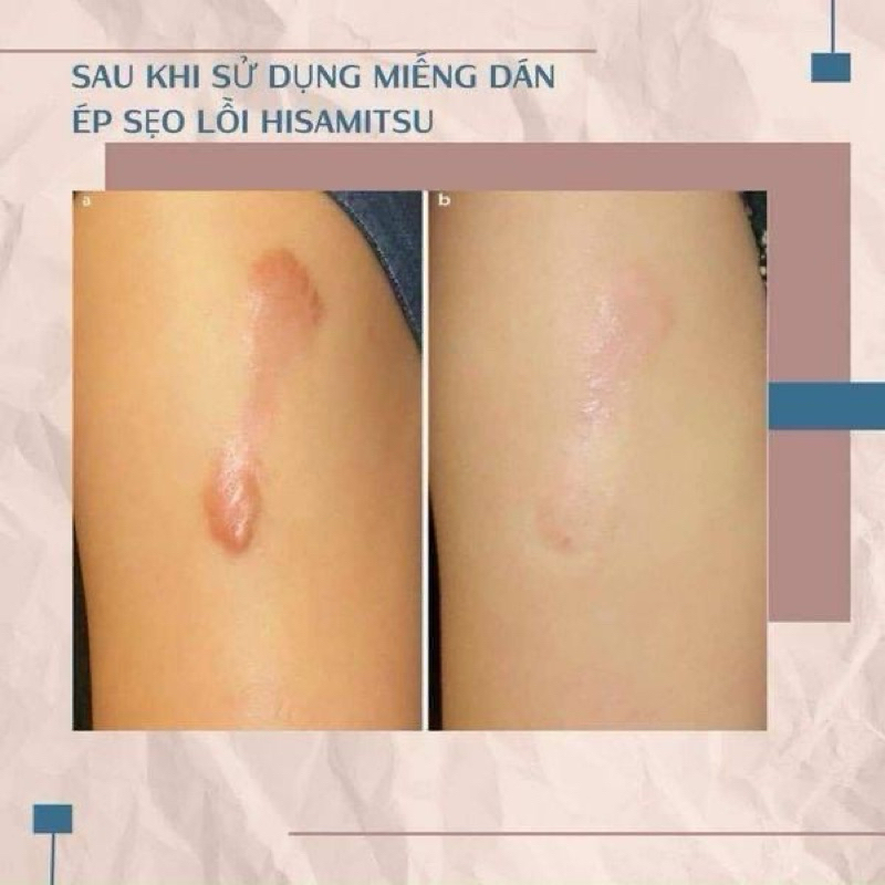 COMBO miếng dán ép sẹo lồi ECLAR PLASTER (HISAMITSU) và DRENISION Nhật Bản