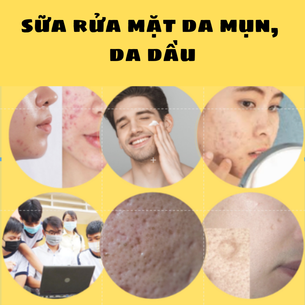 Sữa Rửa Mặt Cho Da Mụn Da Dầu Nhiều