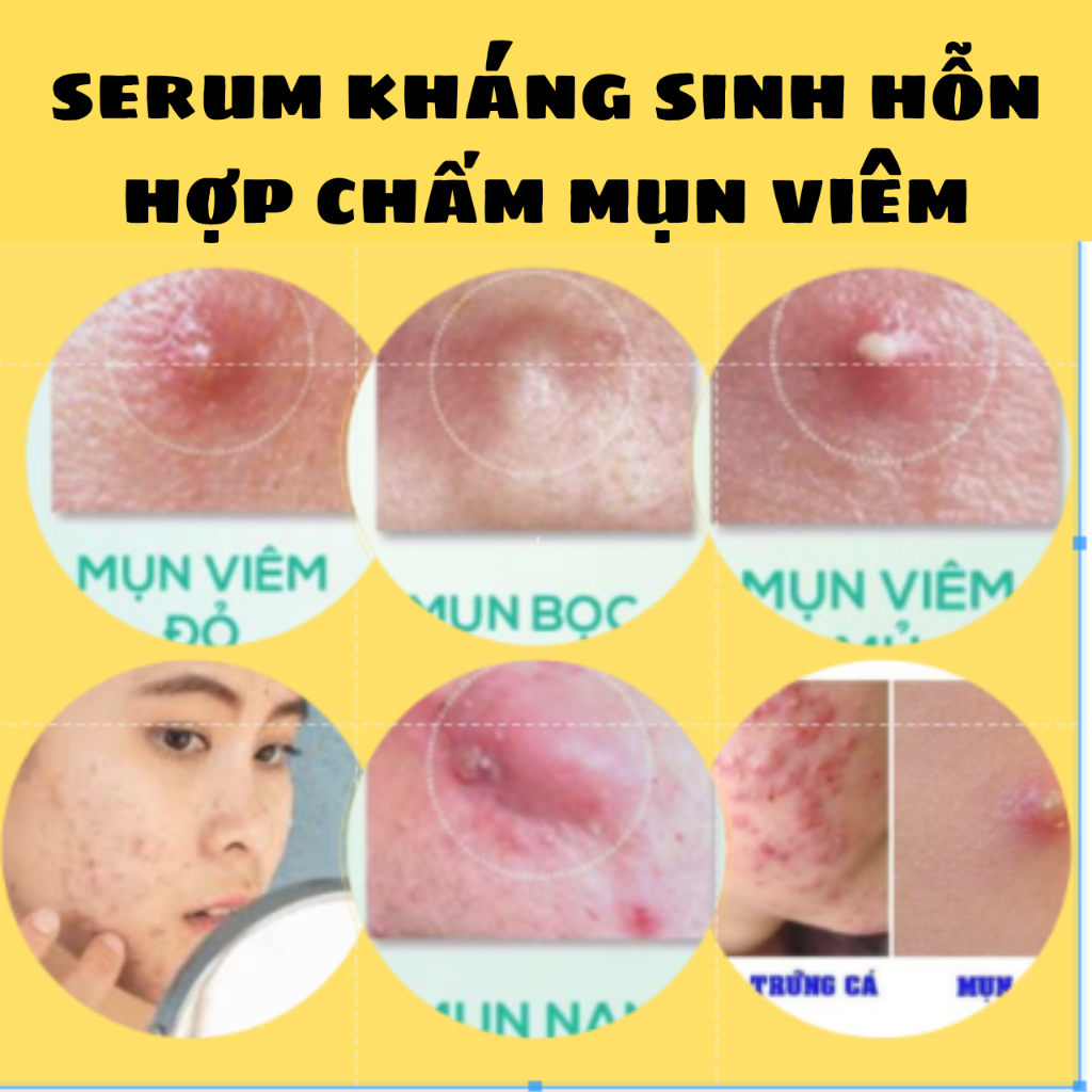 Serum Acnes Kháng Sinh Mụn Cao Cấp.
