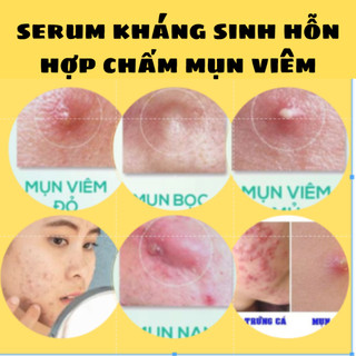 Serum Acnes Kháng Sinh Mụn Cao Cấp.