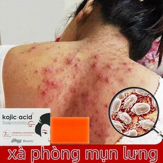 Xà phòng trị mụn xà phòng mụn lưng xà phòng trắng da Xà bông trắng da giảm mụn lưng Xà phòng Kojic Acid