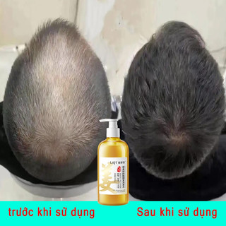 Dầu gội gừng kích mọc tóc dầu gội mọc tóc kích thích mọc tóc dầu gội ngăn rụng tóc hói đầu sau sinh