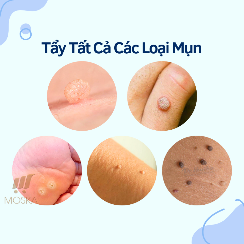 Tẩy Nốt Ruồi, Mụn Thịt, Mụn Cóc, Sẹo Lỗi và Tất Cả Loại Mụn, Đánh bay Các Loại Mụn Của Nga Dvelinil| Mosks Shop