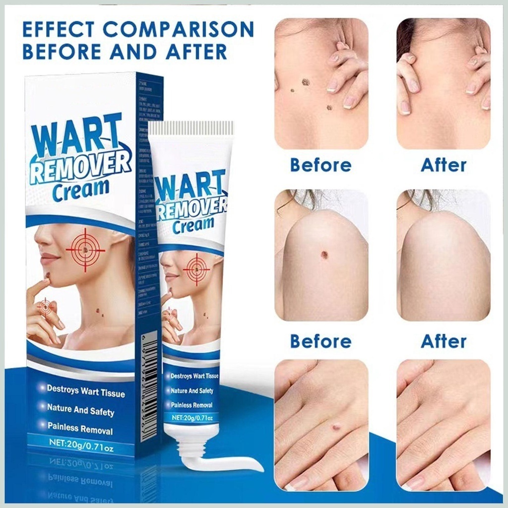 Kem Mụn Thịt Dư, Mụn Cóc  Hbesty Wart Remover Cream - Kem Bật Gốc Cồi Mụn, Rụng Mụn Thịt Dư, Không Đau Ngứa, An Toà