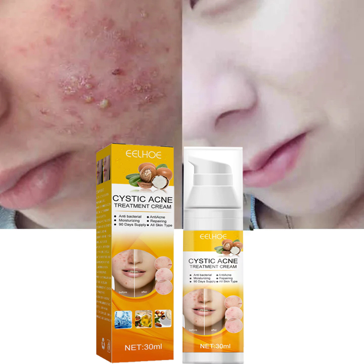 Tinh Chất Đào Thải Mụn Xóa Thâm Sẹo CYSTIC ACE - Xịt Thảo Dược CYSTIC ACE, Cải Thiện Da Mụn, Thu Nhỏ Lỗ Chân Lông