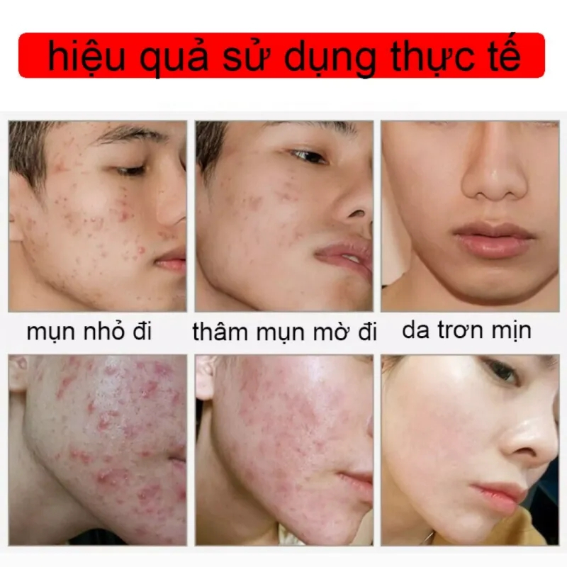 Tinh Chất Đào Thải Mụn Xóa Thâm Sẹo CYSTIC ACE - Xịt Thảo Dược CYSTIC ACE, Cải Thiện Da Mụn, Thu Nhỏ Lỗ Chân Lông