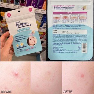 Miếng dán mụn Oliveyoung giảm mụn sưng viêm, gom cồi gói 102 miếng