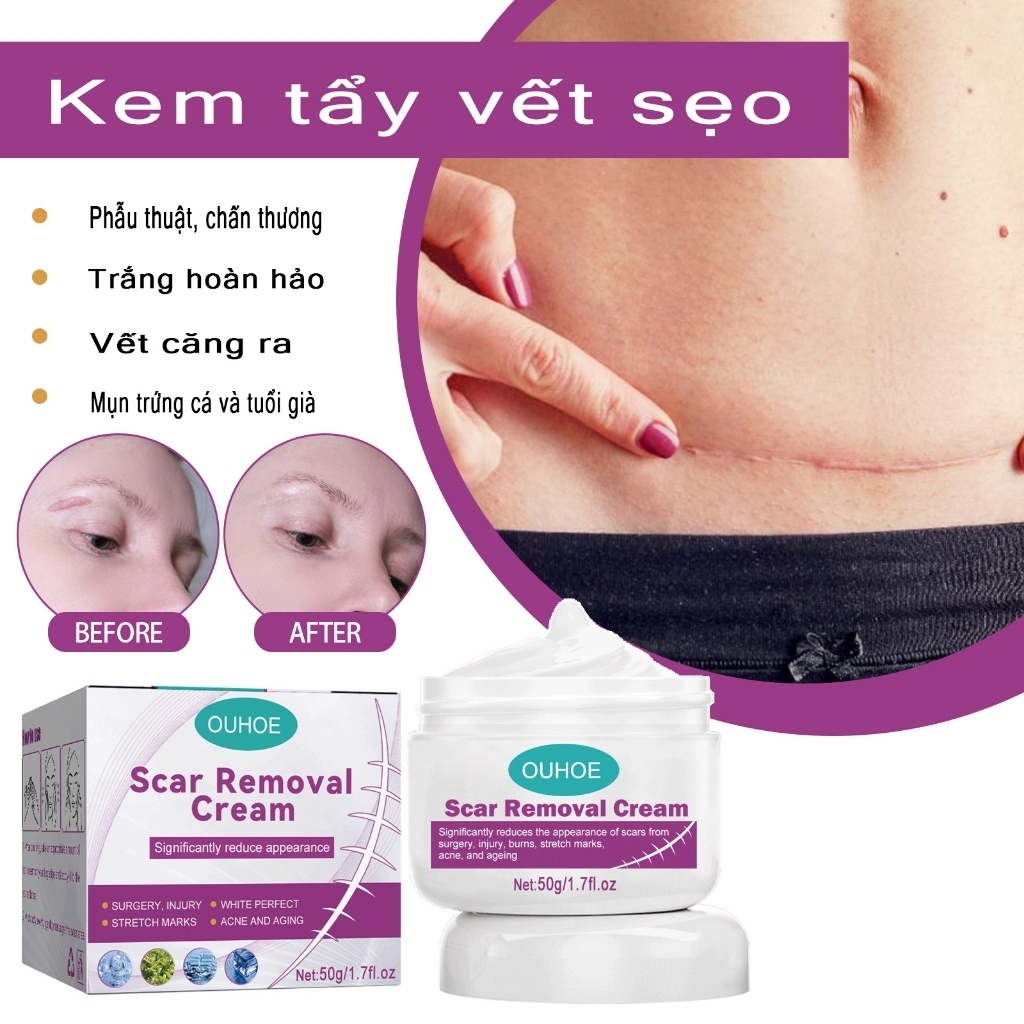 Kem Bôi Sẹo Kem Mờ Sẹo Thâm,mờ sẹo,bôi sẹo,mờ thâm sẹo,liền sẹo và sẹo mụn 50G