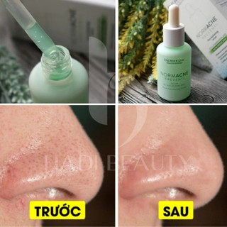 [MUA KÈM DEAL SỐC VỚI GIÁ150K] Tinh chất dưỡng HYDRAIN3 - NORMACNE serum 30ml CẬN DATE