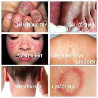 Kem bôi da ITCH KING ( Hàng nhập khẩu Mỹ) 3 tuýp