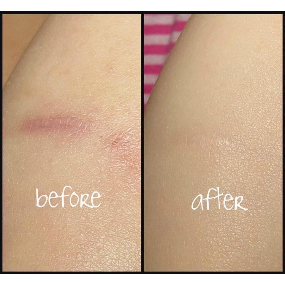 Kem Mờ Sẹo Gentacin Nhật Bản, Kem Giúp Làm Mờ Vết Sẹo Lồi, Sẹo Lõm - 1 Tuýp 10gr