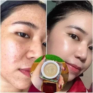 CAO MỤN SÂM ĐỎ 36 VỊ Hộp lớn 15g(chính hãng 100%)