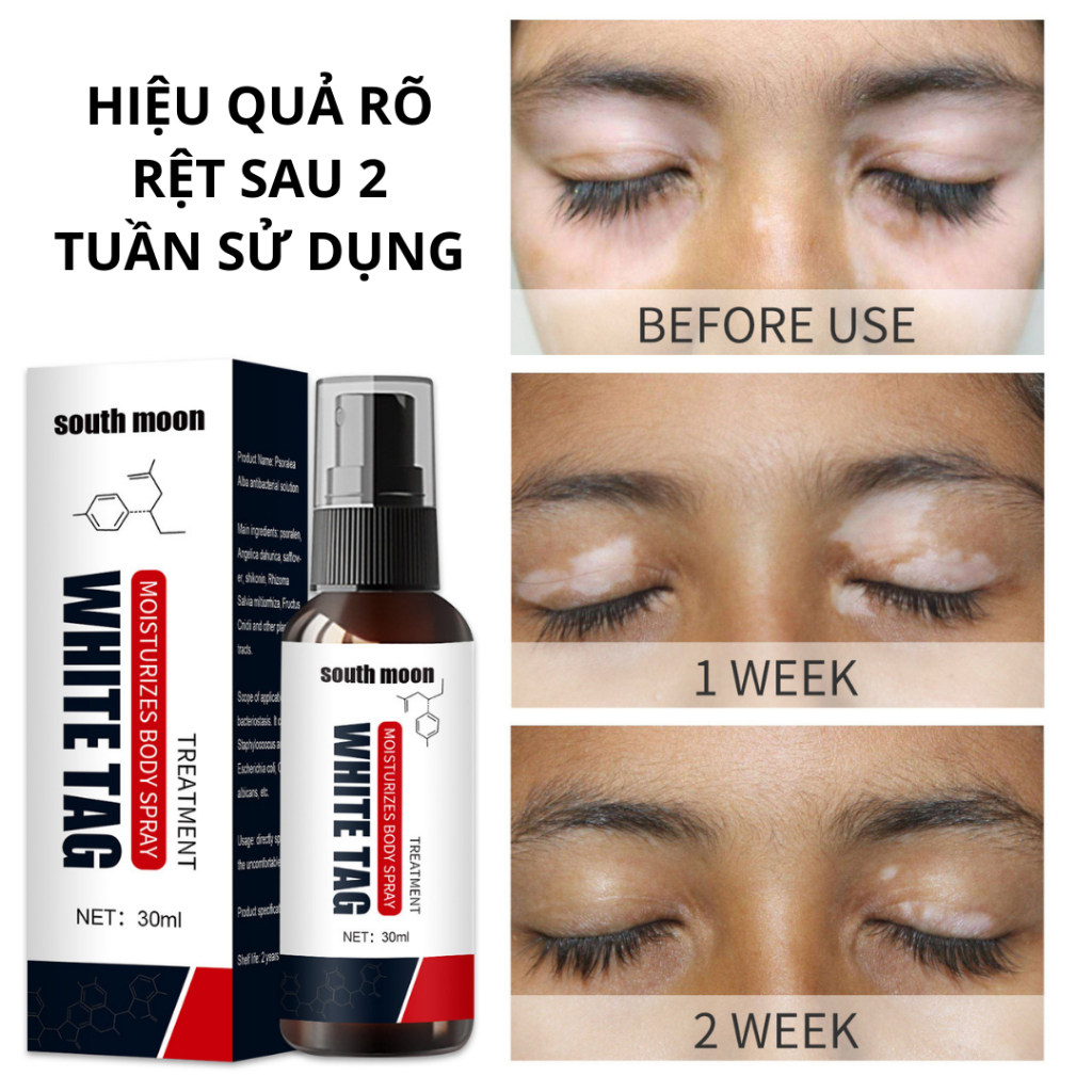 Tinh Chất White Tag Loại Bỏ Nấm Ngứa, Lang Ben, Da Cơ Địa, Bạch Biến, Đốm Trắng Da - Xịt Bạch Biến White Tag 30ml