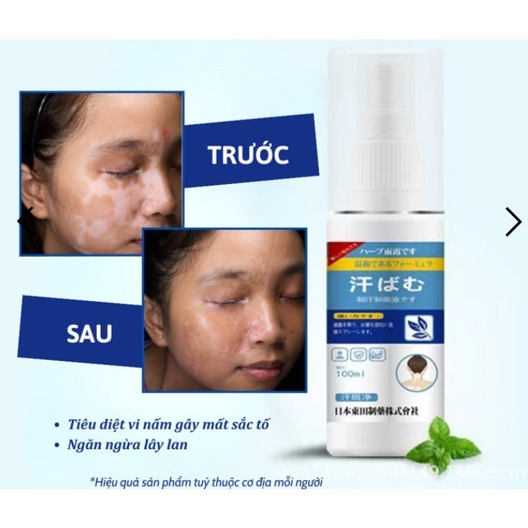 Xịt Bạch Biến Nhật Bản Senko - Xit Thảo Dược Cổ Truyền Senko Làm Đều Tông Màu Da, Xóa Tan Đôm Trắng và Lang Ben